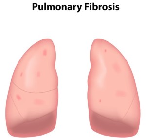 Fibrosi polmonare idiopatica