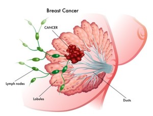 Tumore lobulare al seno