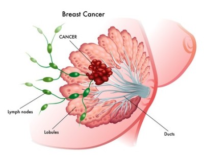 Tumore lobulare al seno: aperta la via a un nuovo approccio terapeutico