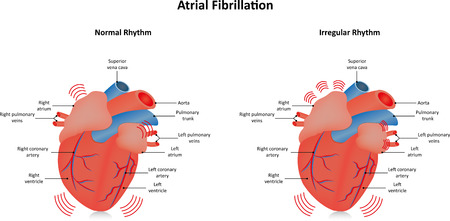 Fibrillazione atriale, LIXIANA ok dal CHMP in pazienti sottoposti a cardioversione