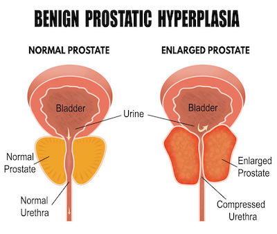 Iperplasia Prostatica Benigna