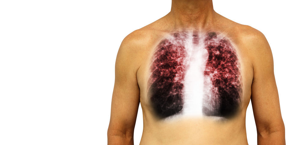 Malattia Interstiziale Polmonare