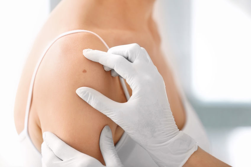 Melanoma