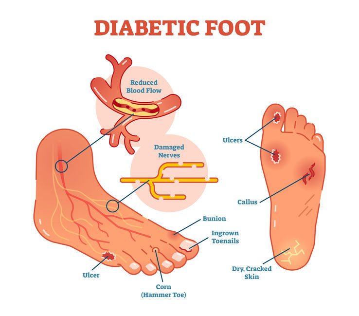 Piede Diabetico