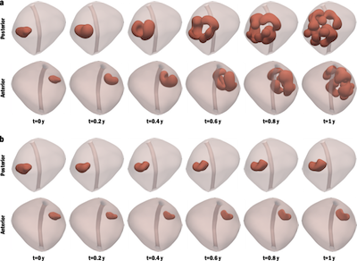Progressione Prostata