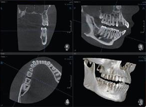 Tac Dentale