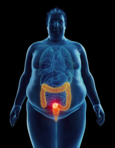 Tumori Dell’apparato Digerente E Obesità: A Trieste Si Parla Di Patologie In Aumento E Nuove Cure
